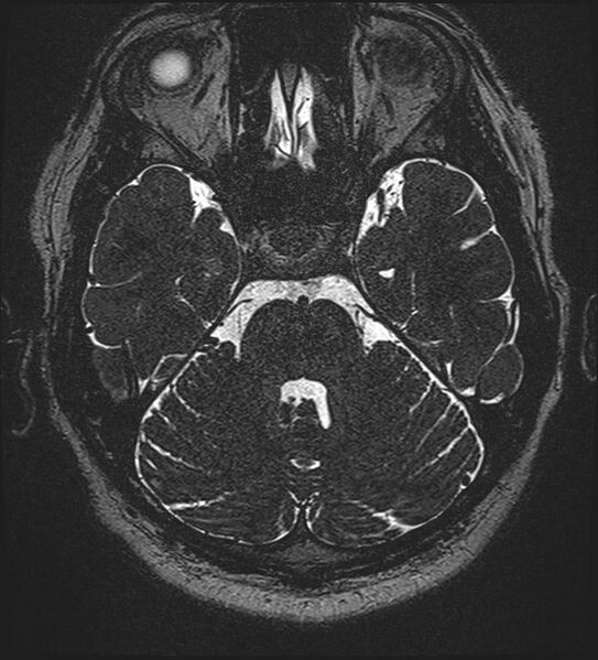 File:Cochlear incomplete partition type III associated with hypothalamic hamartoma (Radiopaedia 88756-105498 Axial T2 106).jpg