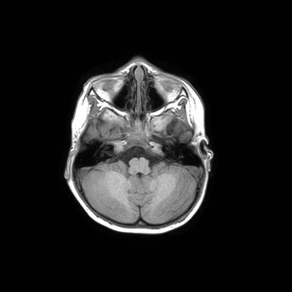 File:Cochlear nerve aplasia - unilateral (Radiopaedia 87910-104413 Axial T1 9).jpg