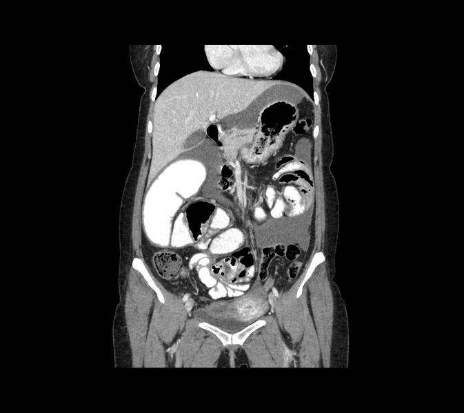 File:Cocoon abdomen with possible tubo-ovarian abscess (Radiopaedia 46235-50636 B 21).jpg