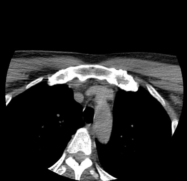 File:Colloid cyst of thyroid (Radiopaedia 22897-22923 Axial non-contrast 60).jpg