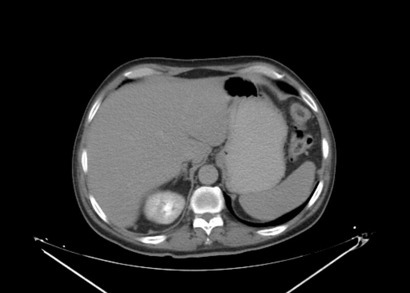 File:Colon cancer mimicking renal cell carcinoma (Radiopaedia 28986-29335 Axial C+ delayed 13).jpg