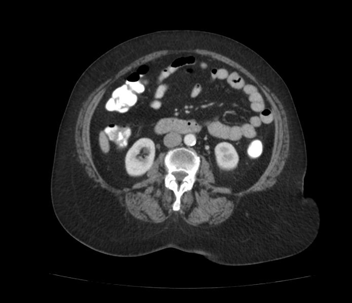 File:Colonic diverticulosis (Radiopaedia 22934-22957 A 35).jpg