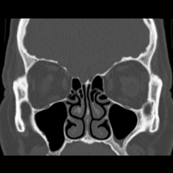 File:Nasolabial cyst (Radiopaedia 33987-35205 Coronal bone window 36).jpg