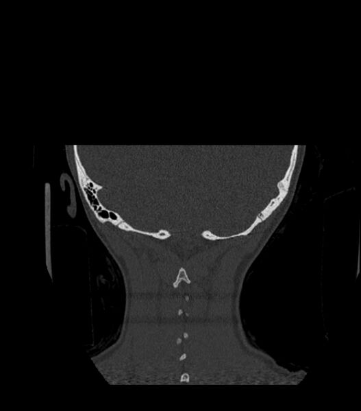 File:Nasoorbitoethmoid fracture (Radiopaedia 90044-107205 Coronal bone window 130).jpg
