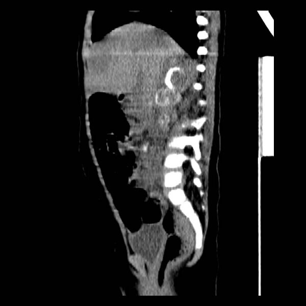 File:Neuroblastoma with skull metastases (Radiopaedia 30326-30960 B 18).jpg