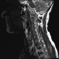 Neurofibromatosis type 1 (Radiopaedia 80355-93740 Sagittal T2 8).jpg