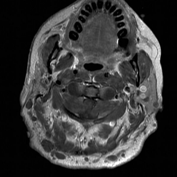 File:Neurofibromatosis type 1 (Radiopaedia 9159-9859 Axial T1 C+ 1).jpg