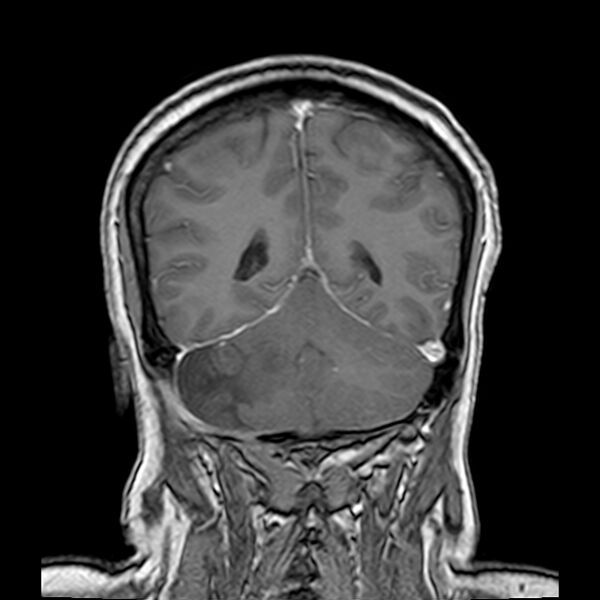 File:Neurofibromatosis type 2 (Radiopaedia 67470-76871 Coronal T1 C+ 18).jpg