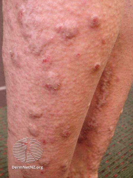 File:Nodular prurigo (DermNet NZ dermatitis-prurigo1).jpg