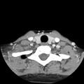 Normal CT of the neck (Radiopaedia 14575-14500 Axial C+ 54).jpg