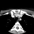 Normal CT of the neck (Radiopaedia 14575-14500 Axial C+ 73).jpg