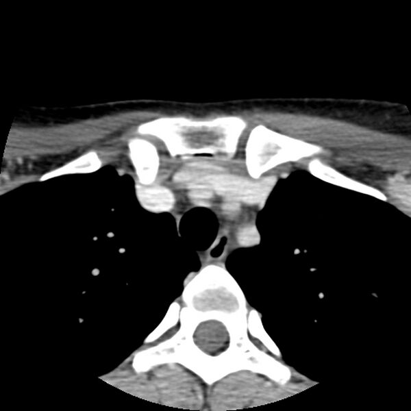 File:Normal CT of the neck (Radiopaedia 14575-14500 Axial C+ 73).jpg
