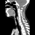 Normal CT of the neck (Radiopaedia 14575-14500 Sagittal C+ 29).jpg