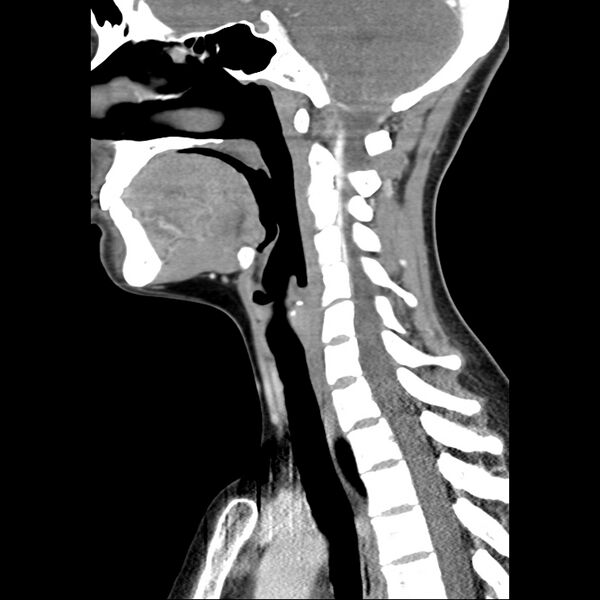 File:Normal CT of the neck (Radiopaedia 14575-14500 Sagittal C+ 29).jpg