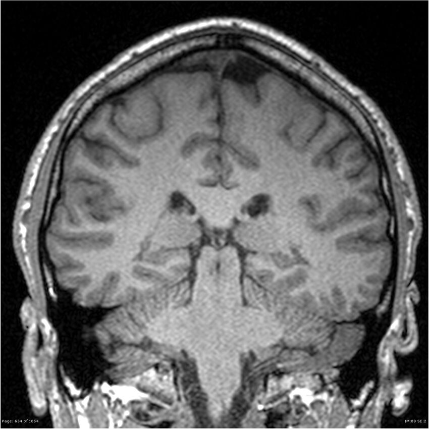 Normal brain MRI (non-focal epilepsy protocol) (Radiopaedia 38571-40700 Coronal T1 43).jpg