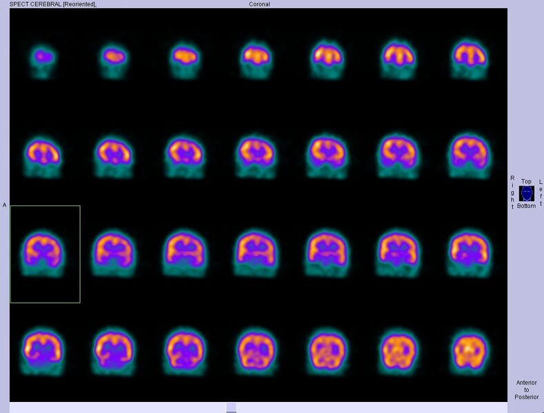 File:Normal brain perfusion SPECT (Radiopaedia 30090-30673 Coronal 1).jpg