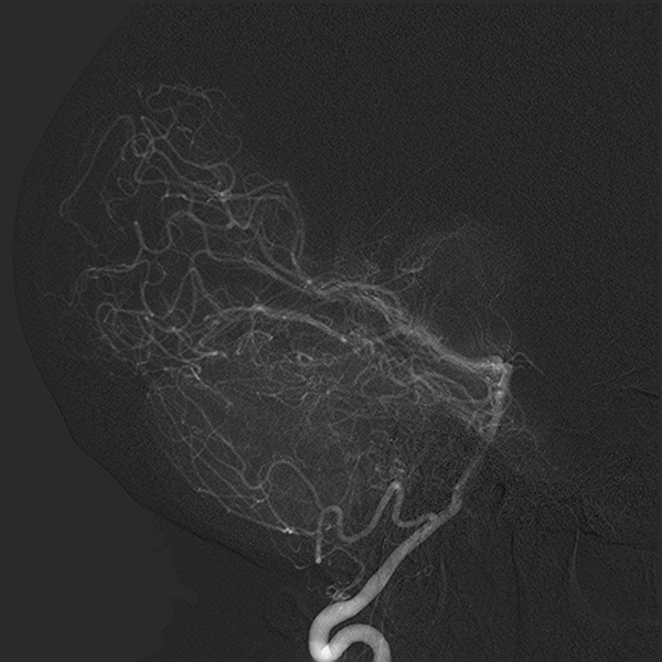 File:Normal cerebral angiogram (four vessel DSA) (Radiopaedia 41708-44649 L 10).png