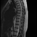 Normal cervical and thoracic spine MRI (Radiopaedia 35630-37156 G 7).png