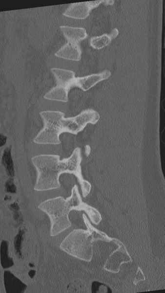 File:Normal lumbar spine CT (Radiopaedia 46533-50986 Sagittal bone window 39).png