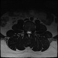 Normal lumbar spine MRI (Radiopaedia 47857-52609 Axial T2 1).jpg