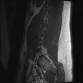 Normal lumbar spine MRI (Radiopaedia 47857-52609 Sagittal T1 19).jpg