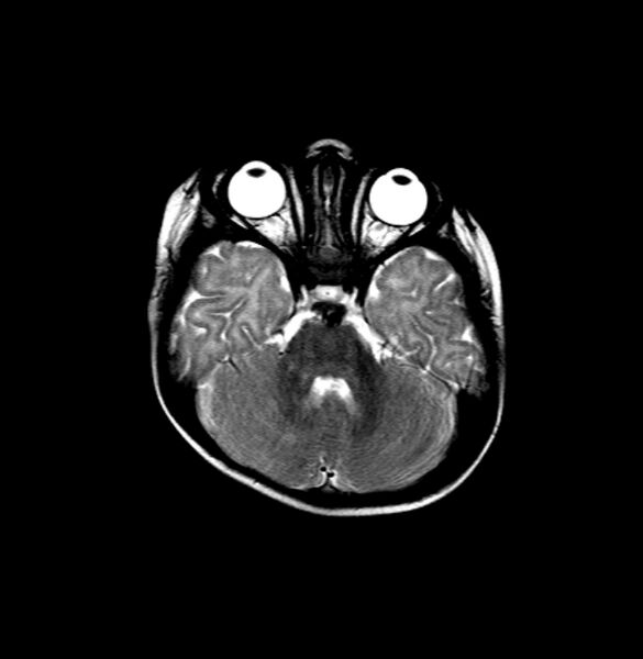 File:Normal myelination 5 month old (Radiopaedia 6814-7982 Axial T2 2).jpg