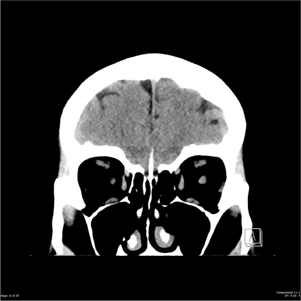 File:Normal pressure hydrocephalus (Radiopaedia 24415-24736 Coronal non-contrast 4).jpg