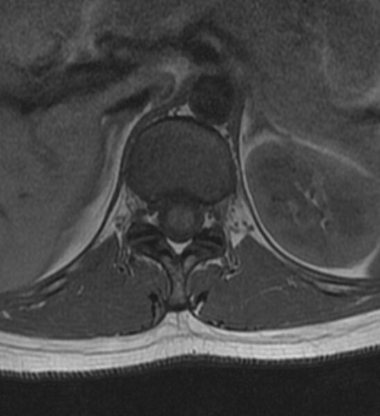 File:Normal thoracic spine MRI (Radiopaedia 41033-43781 Axial T1 26).jpg