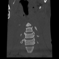 Normal trauma cervical spine (Radiopaedia 41017-43760 Coronal bone window 7).png