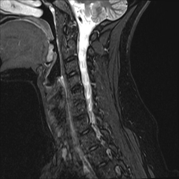 File:Normal trauma cervical spine MRI (Radiopaedia 32130-33071 Sagittal STIR 5).jpg