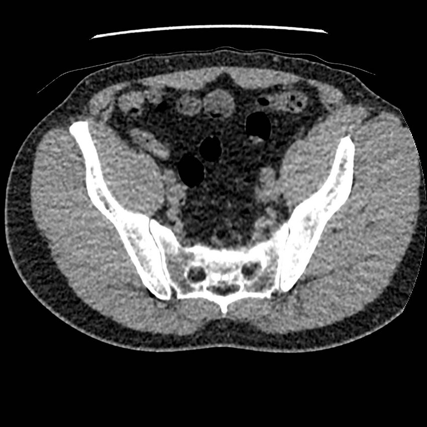 Obstructing ureteric calculus and ureteric anatomy (Radiopaedia 62730-71042 Axial non-contrast 130).jpg