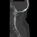 Occipital condyle fracture (Radiopaedia 18366-18208 Sagittal bone window 27).jpg