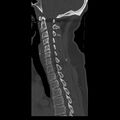 Occipital condyle fracture (Radiopaedia 31755-32691 Sagittal bone window 17).jpg