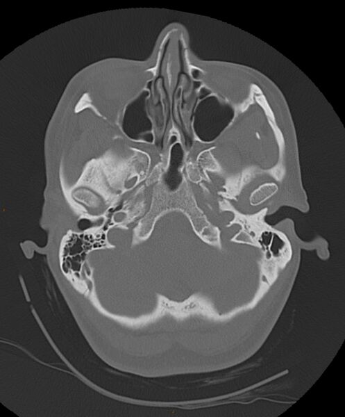 File:Occipital condyle fracture (Radiopaedia 61165-69056 Axial bone window 20).jpg