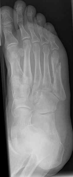 File:5th metatarsal fracture (Radiopaedia 6460-7813 Oblique 1).jpg