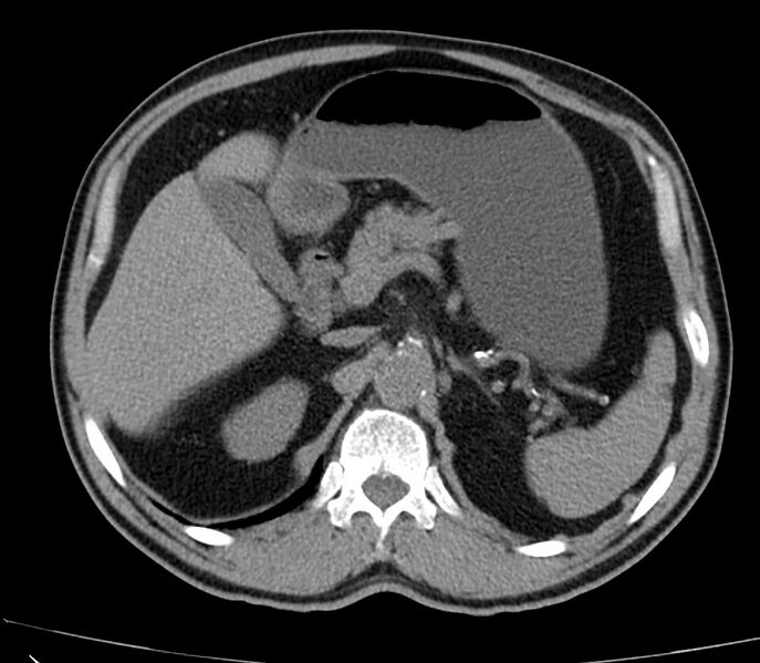 File:Abdominal aortic aneurysm (Radiopaedia 22421-22458 non-contrast 15).jpg