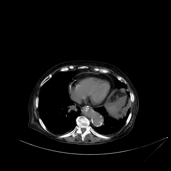 File:Abdominal aortic aneurysm - impending rupture (Radiopaedia 19233-19246 Axial non-contrast 14).jpg