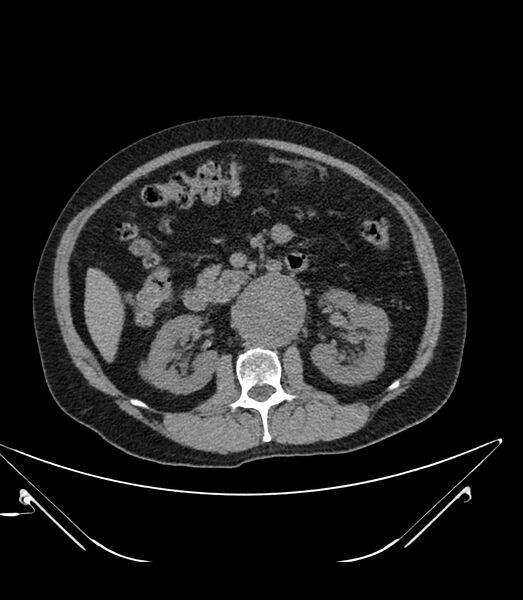 File:Abdominal aortic aneurysm with thrombus fissuration (Radiopaedia 46218-50618 Axial non-contrast 21).jpg