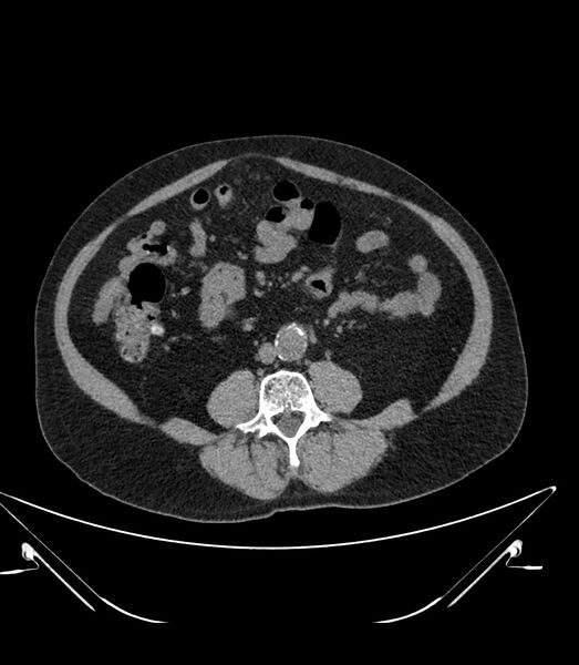 File:Abdominal aortic aneurysm with thrombus fissuration (Radiopaedia 46218-50618 Axial non-contrast 31).jpg