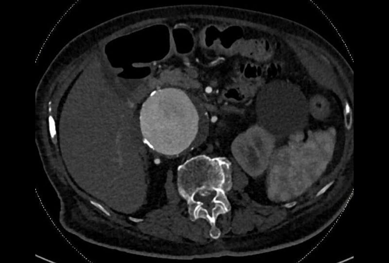 File:Abdominal aortic aneurysm with thrombus fissuration (Radiopaedia 73192-83919 Axial C+ arterial phase 53).jpg