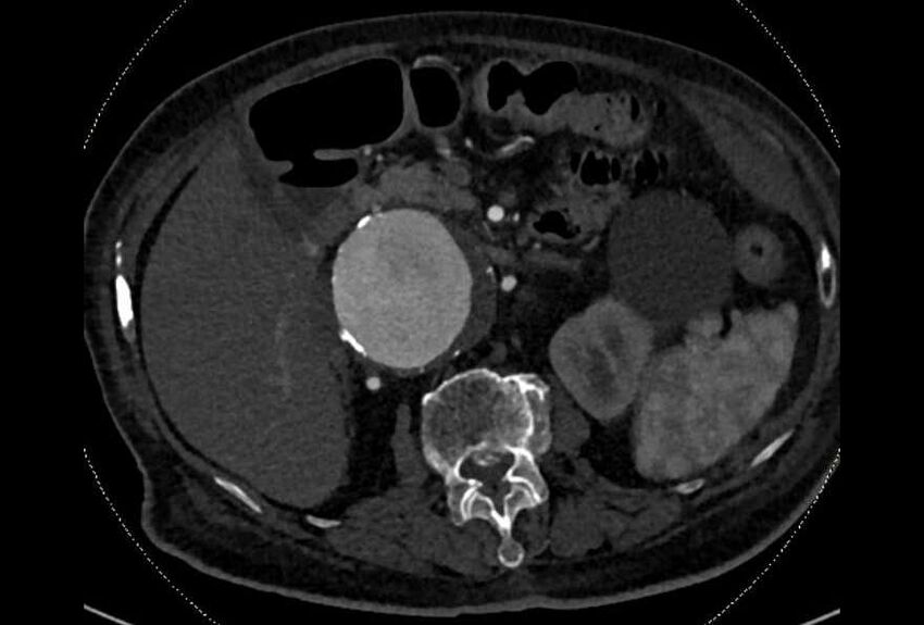 Abdominal aortic aneurysm with thrombus fissuration (Radiopaedia 73192-83919 Axial C+ arterial phase 53).jpg