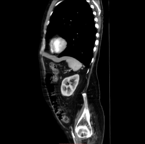 File:Abdominal aortic interposition tube graft and aneurysm thrombosis (Radiopaedia 71438-81857 Sagittal C+ arterial phase 6).jpg