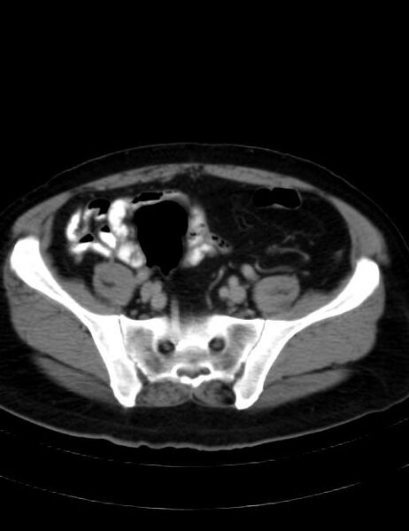 File:Abdominal lymphoma - with sandwich sign (Radiopaedia 53486-59492 Axial C+ portal venous phase 38).jpg