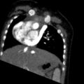 Aberrant left pulmonary artery (pulmonary sling) (Radiopaedia 42323-45435 Coronal C+ CTPA 16).jpg