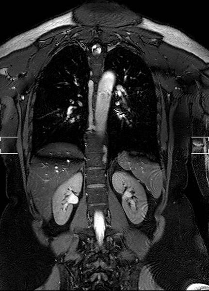 File:Aberrant right subclavian artery with background Takayasu arteritis (Radiopaedia 21423-21363 Coronal MRA 25).jpg