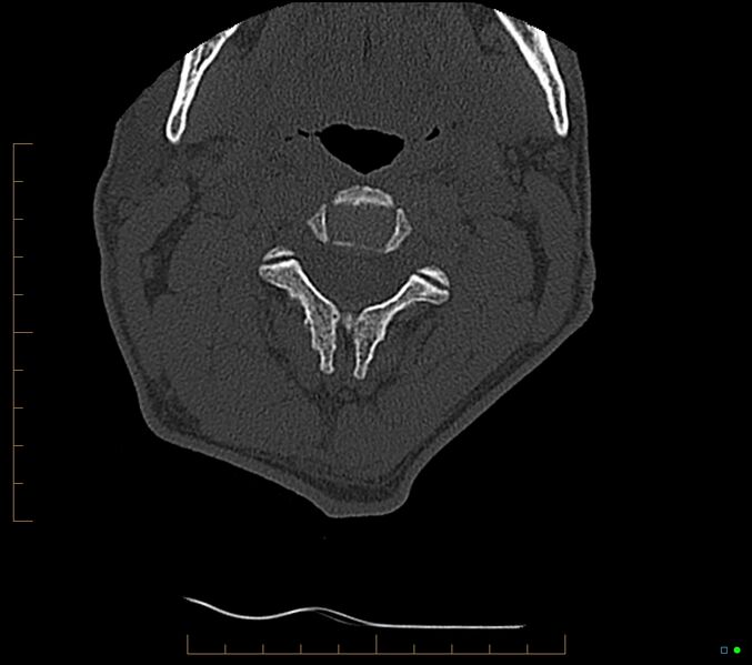 File:Accessory articulation of cervical transverse processes (Radiopaedia 82715-96933 Axial non-contrast 44).jpg