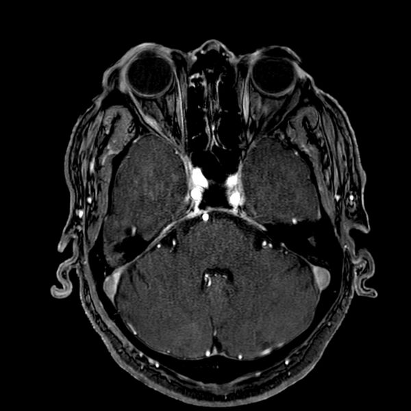 File:Accessory middle cerebral artery (Radiopaedia 73114-83828 Axial MRA 45).jpg
