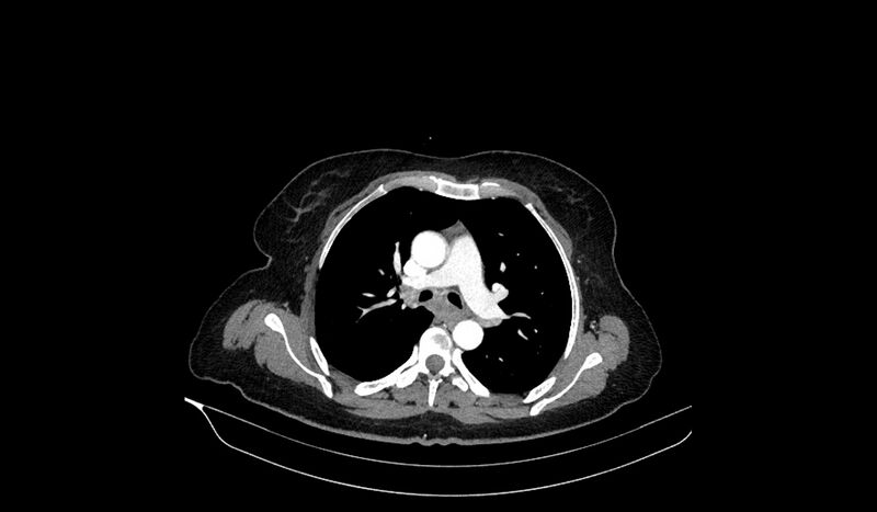 File:Acquired tracheo-esophageal fistula (Radiopaedia 51356-57103 Axial C+ arterial phase 43).jpg