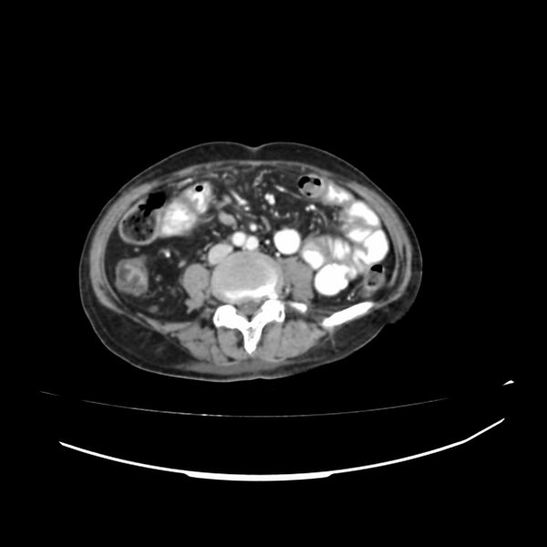 File:Acute-on-chronic Crohn disease with enteroenteric fistula (Radiopaedia 66686-75987 B 16).jpg