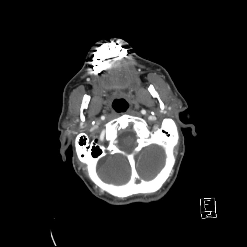 Acute ICA ischemic penumbra due to high-grade CCA stenosis (CT perfusion) (Radiopaedia 72038-82530 Axial C+ arterial phase 26).jpg